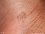 tinea nigra