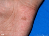 tinea nigra