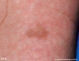 tinea nigra