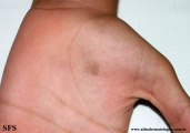 tinea nigra