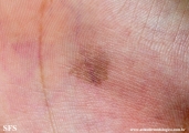 tinea nigra