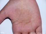 tinea nigra