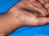 tinea nigra