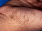 tinea nigra