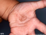 tinea nigra