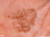 tinea nigra