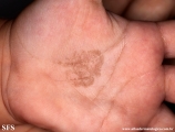 tinea nigra