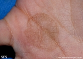 tinea nigra