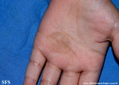 tinea nigra