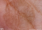tinea nigra