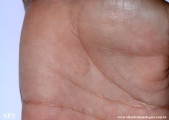 tinea nigra