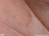 tinea nigra
