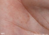tinea nigra