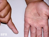 tinea nigra