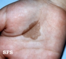 tinea nigra