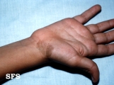 tinea nigra