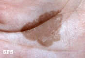 tinea nigra