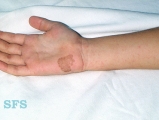tinea nigra