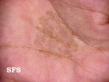 tinea nigra