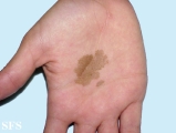 tinea nigra