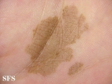 tinea nigra