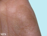 tinea nigra