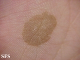 tinea nigra
