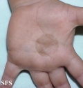 tinea nigra