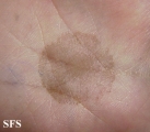 tinea nigra