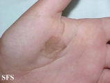 tinea nigra