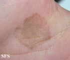 tinea nigra