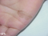 tinea nigra