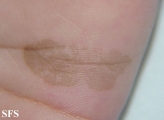 tinea nigra