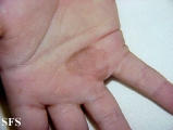 tinea nigra