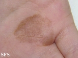 tinea nigra