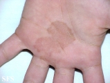 tinea nigra