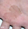 tinea nigra