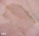 tinea nigra