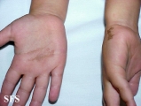 tinea nigra