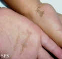 tinea nigra