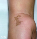 tinea nigra
