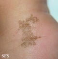 tinea nigra