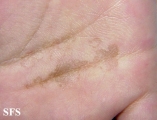 tinea nigra