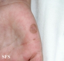 tinea nigra