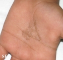 tinea nigra
