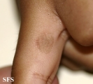 tinea nigra