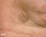 tinea nigra