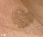 tinea nigra