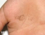 tinea nigra