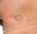 tinea nigra